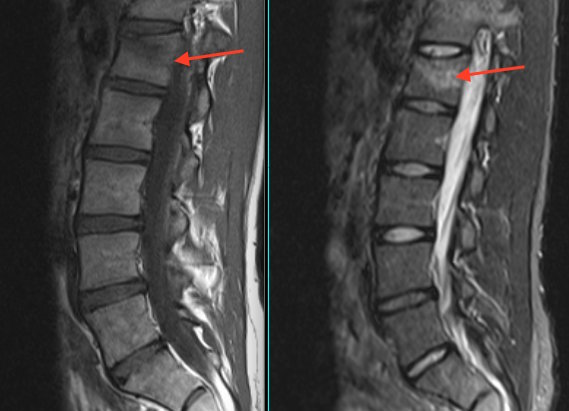 L1 spinal compression fracture